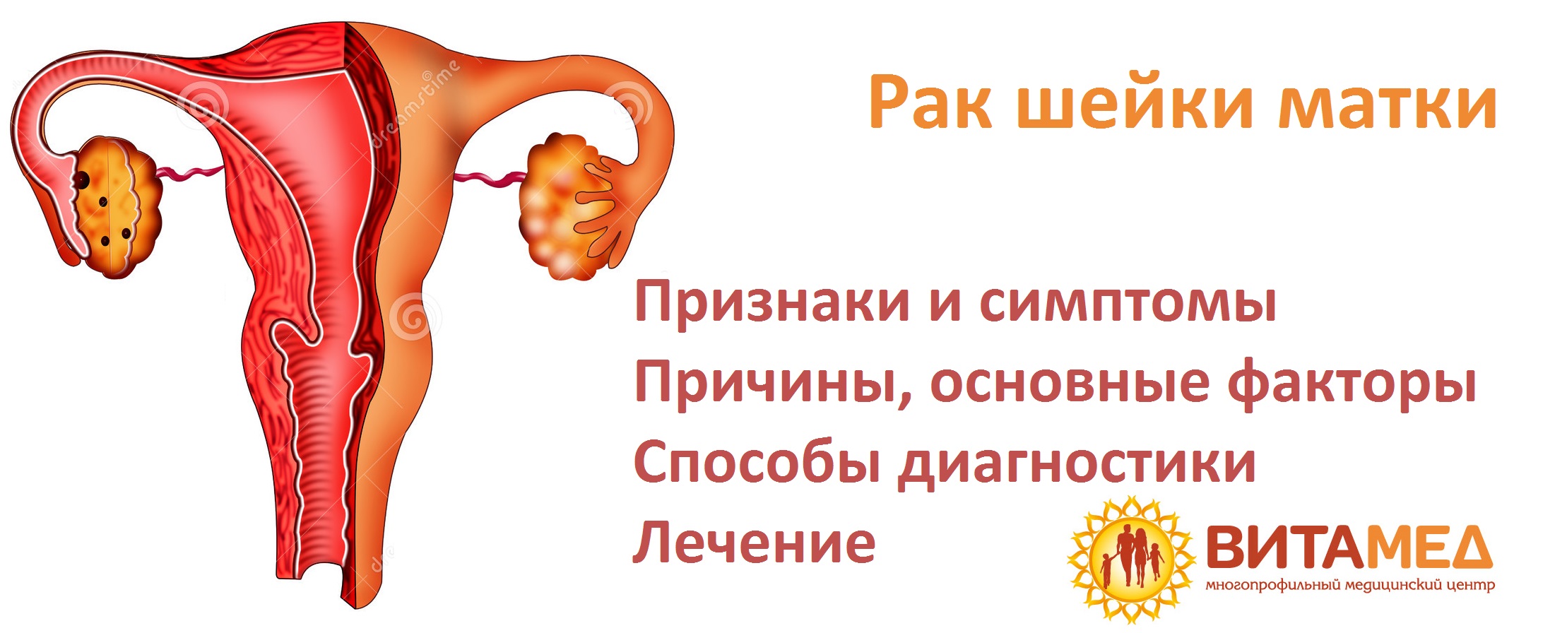 Лечение рака матки  в Москве 